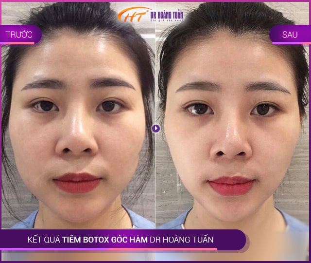Kết quả tiêm botox góc hàm tại Thẩm mỹ Hoàng Tuấn